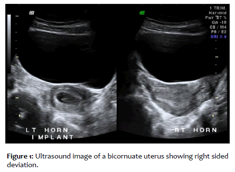 clinical-reproductive-sciences-bicornuate