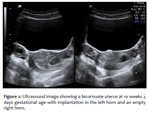 clinical-reproductive-sciences-bicornuate